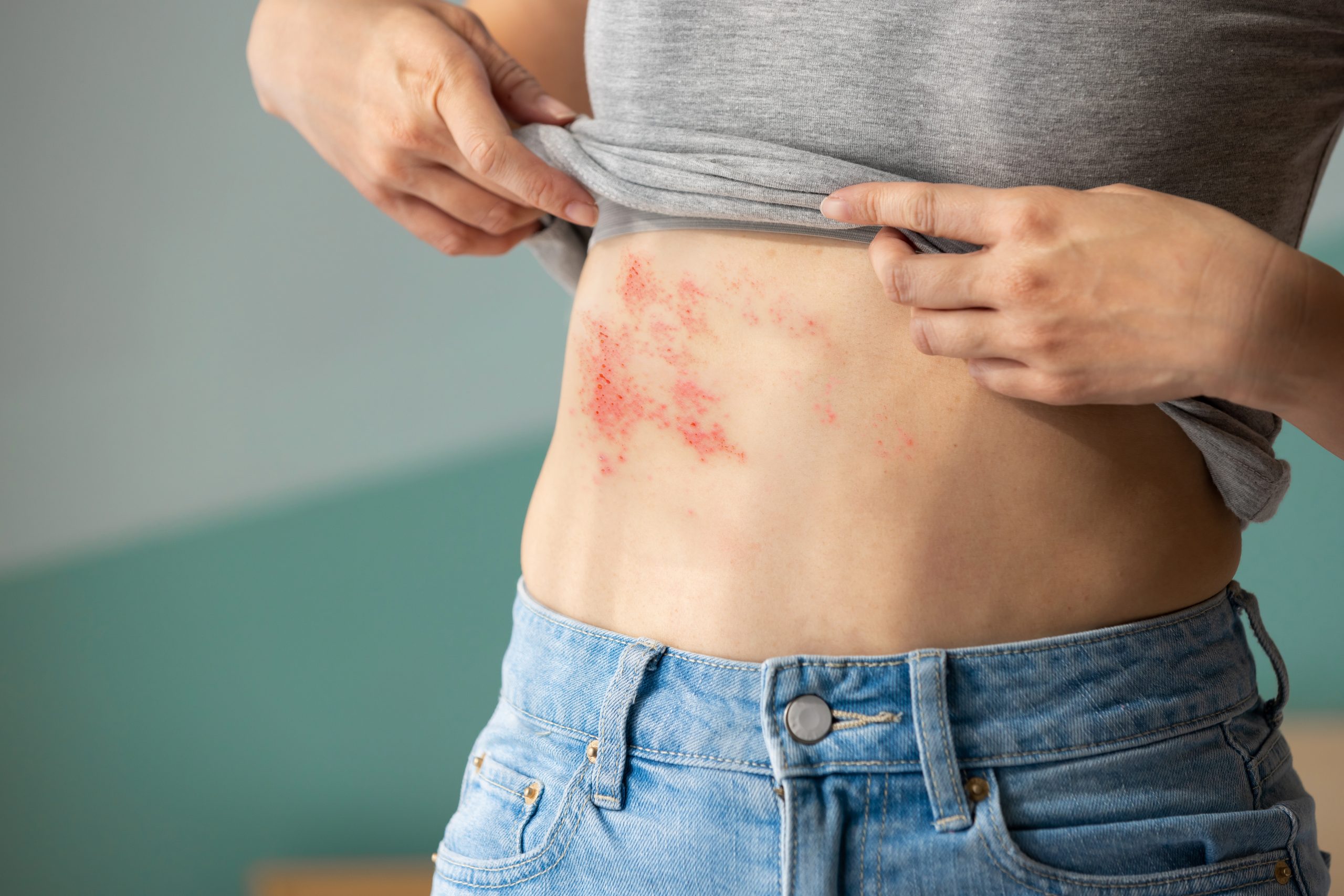 Shingles in Singapore: Prevention and Treatment Strategies